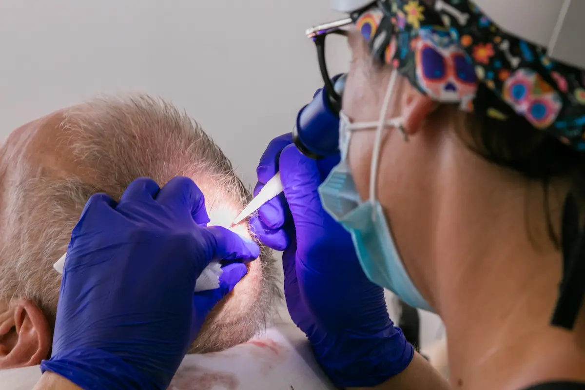 Chirurgien réalisant une greffe de cheveux par technique FUE sur un patient dans un centre spécialisé en restauration capillaire en France.
